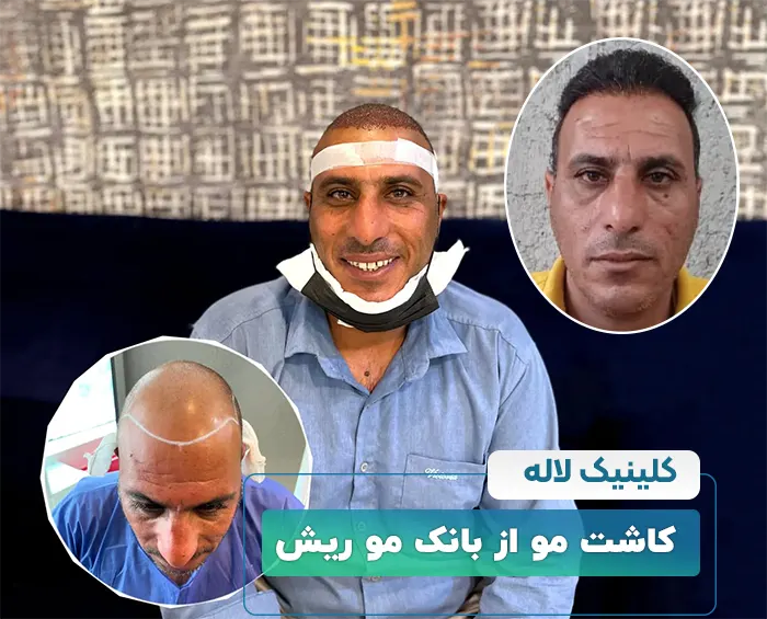 کاشت مو از ریش