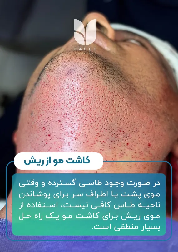کاشت مو از ریش