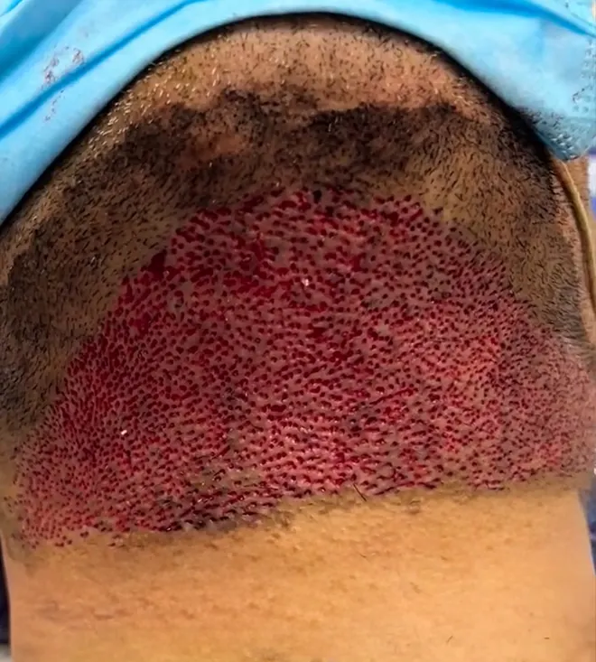 کاشت مو از ریش