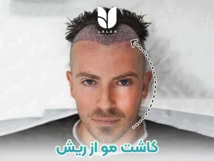 کاشت مو از ریش