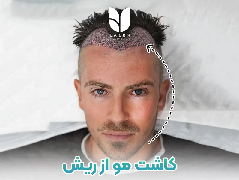 کاشت مو از ریش