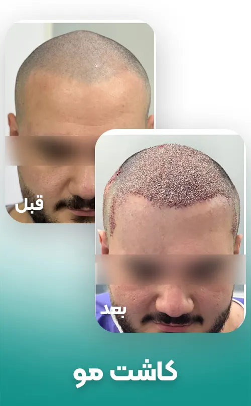 قبل و بعد کاشت مو