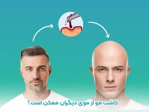 کاشت مو با بانک موی دیگران