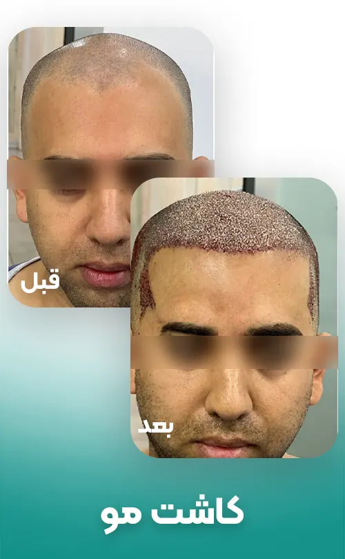 قبل و بعد کاشت مو