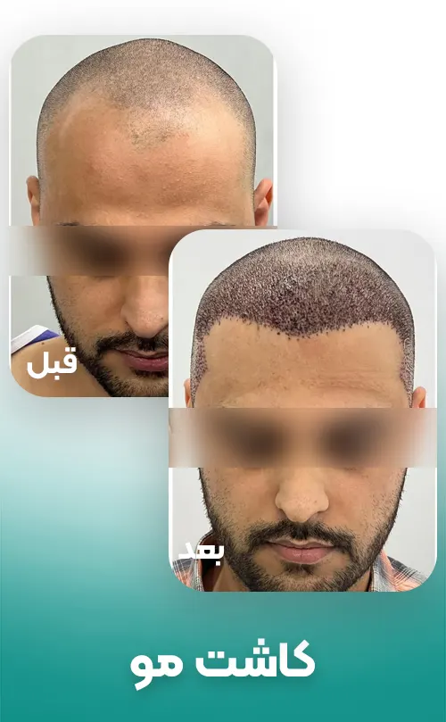 قبل و بعد کاشت مو
