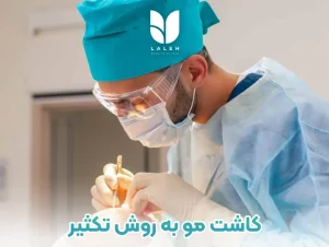 کاشت مو به روش تکثیر