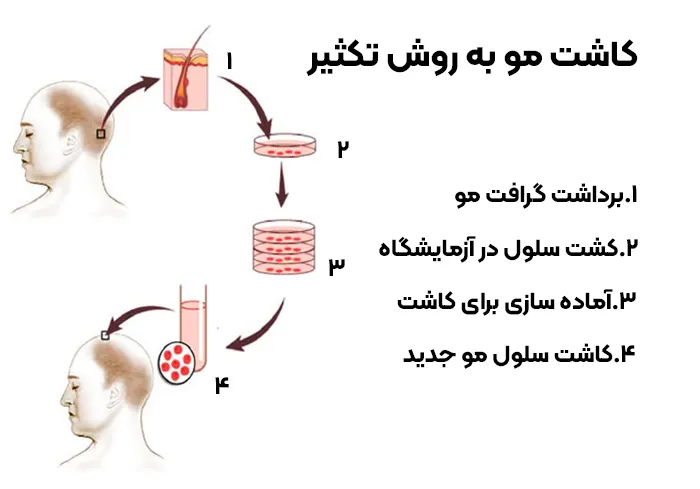 کاشت مو به روش تکثیر