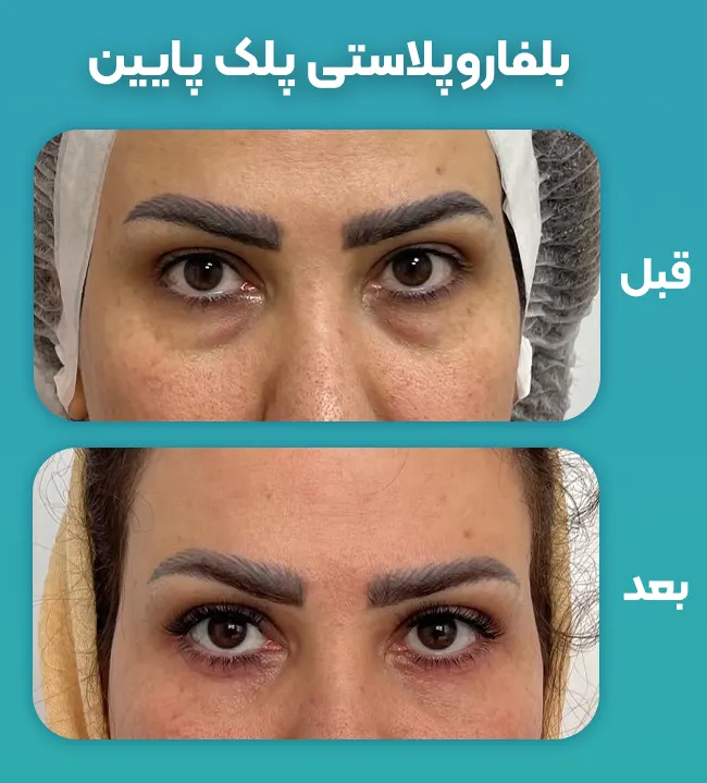 بلفاروپلاستی پلک پایین قبل بعد