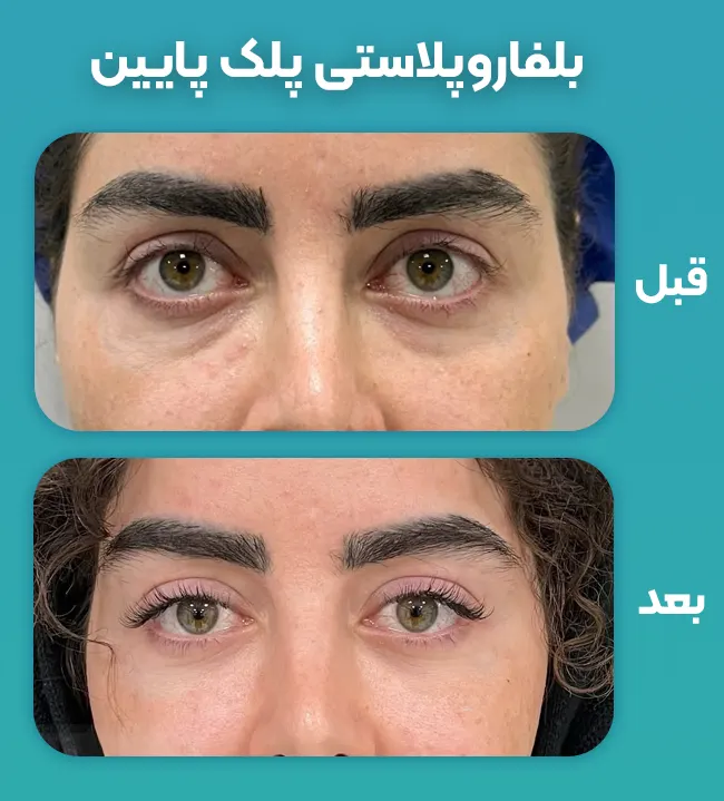 بلفاروپلاستی پلک پایین