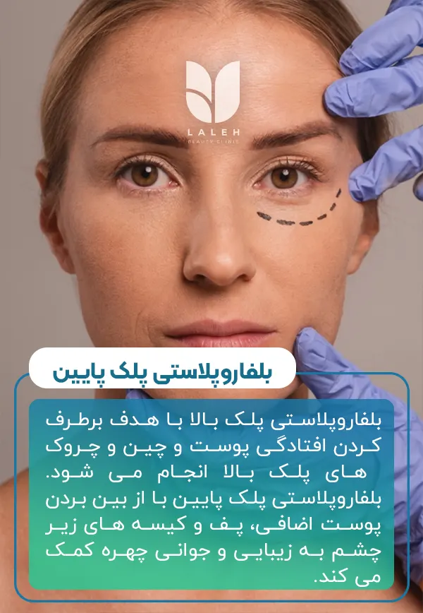 بلفاروپلاستی پلک پایین