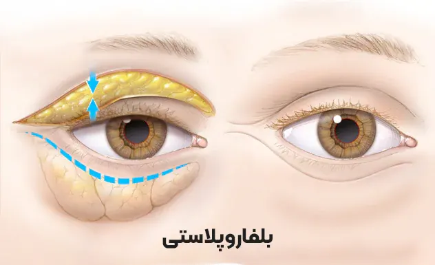 بلفاروپلاستی