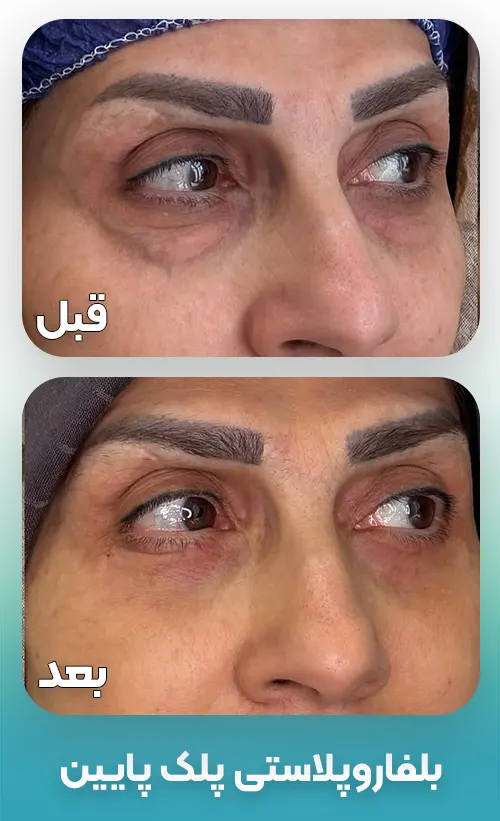 بلفاروپلاستی پلک پایین