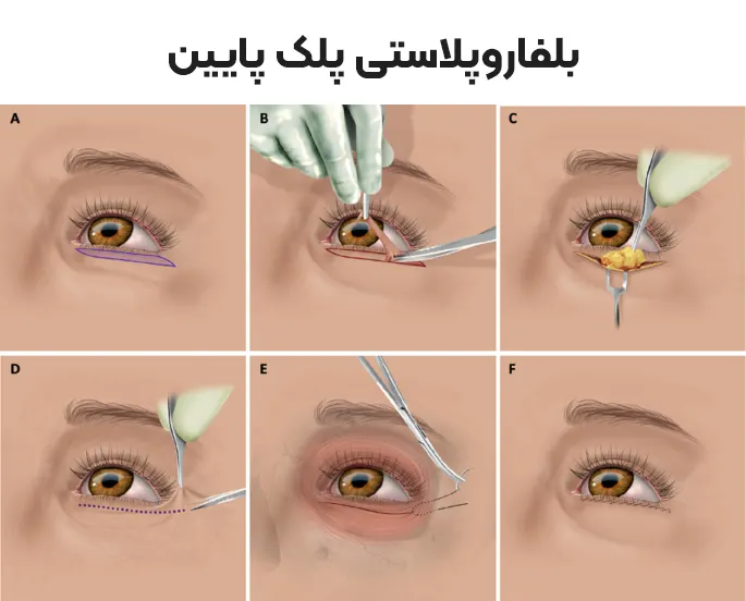 مراحل بلفاروپلاستی پلک پایین