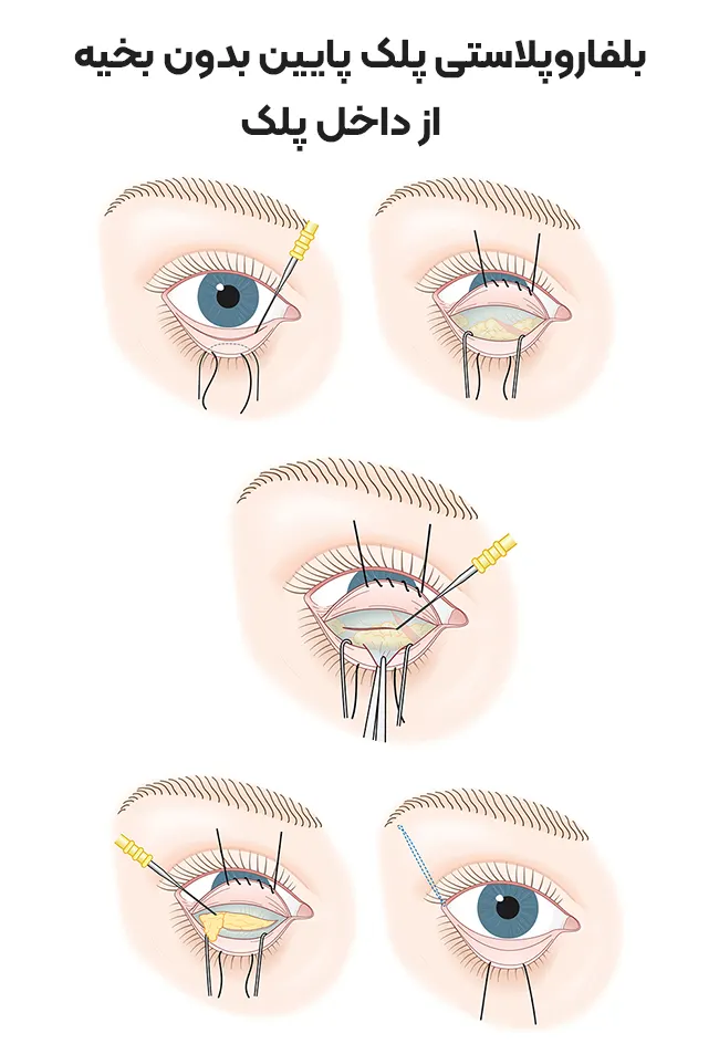 بلفاروپلاستی پلک پایین از داخل