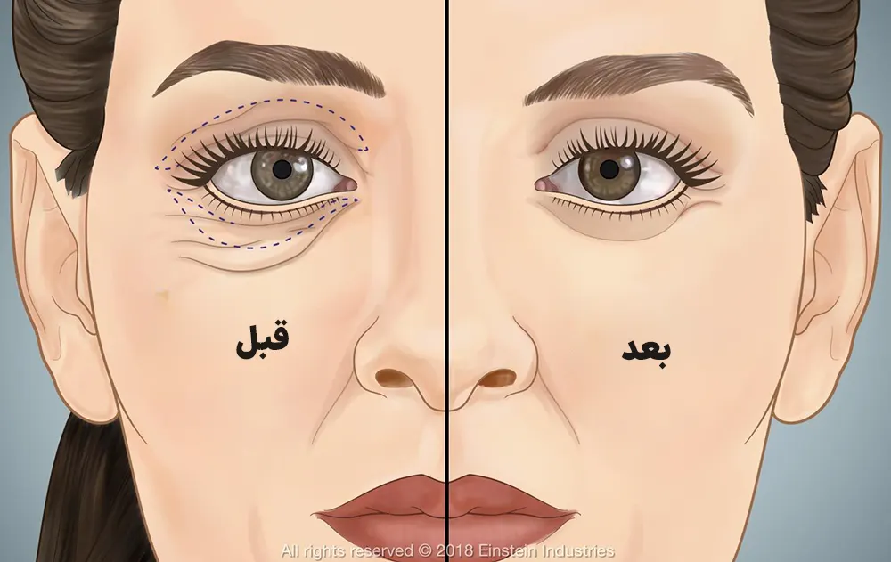 بلفاروپلاستی پلک پایین