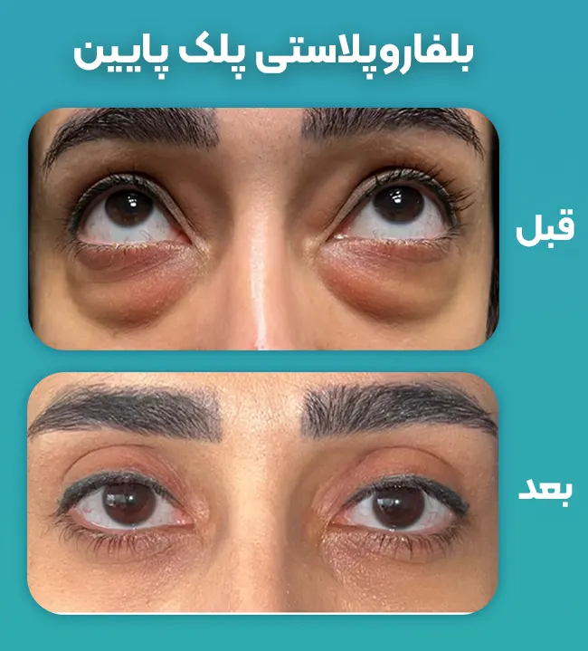 درمان پف زیر چشم