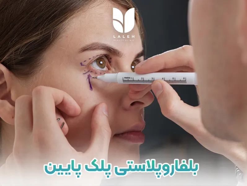 بلفاروپلاستی پلک پایین