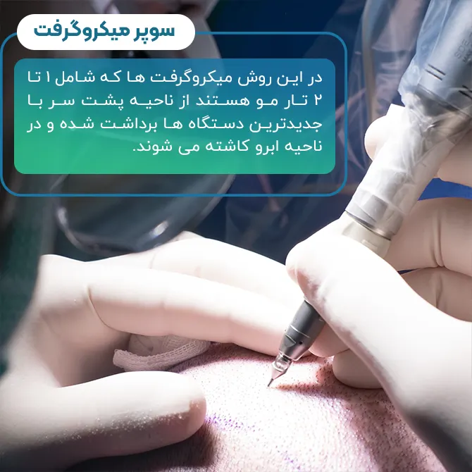کاشت ابرو به روش سوپر میکروگرفت