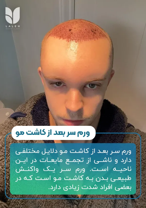 ورم سر بعد از کاشت مو