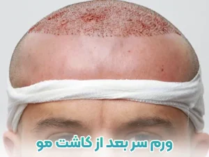 ورم سر بعد از کاشت مو