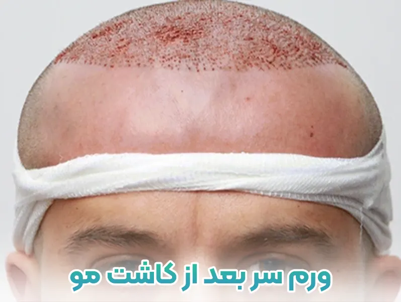 ورم سر بعد از کاشت مو