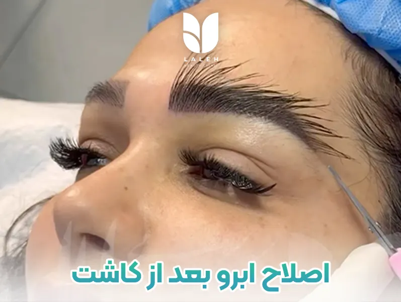 اصلاح ابرو بعد از کاشت
