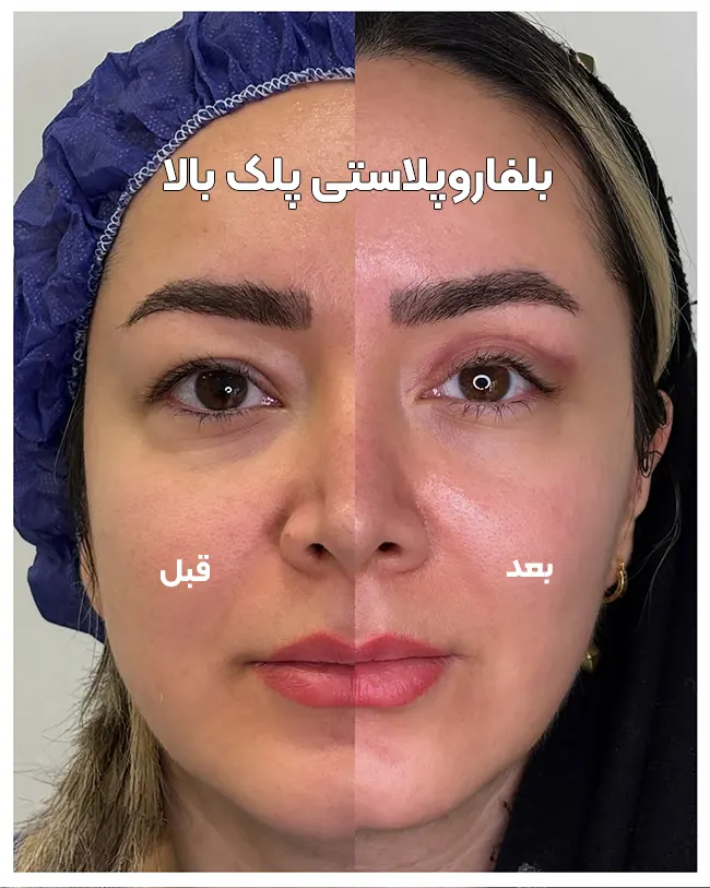 بلفاروپلاستی پلک بالا