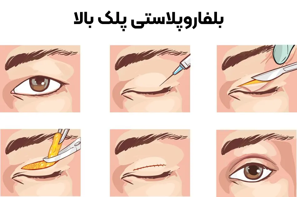 بلفاروپلاستی پلک بالا