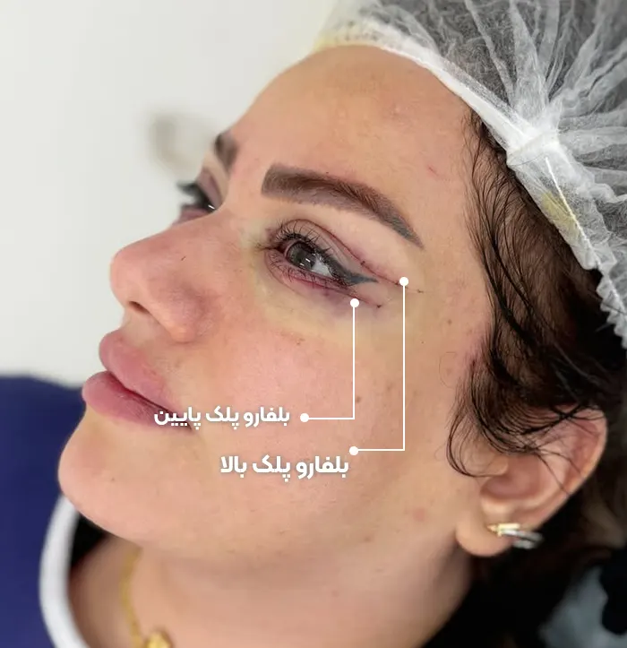 تفاوت بلفاروپلاستی پلک بالا و پایین