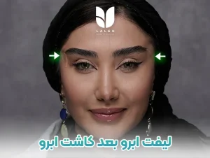 لیفت ابرو بعد کاشت ابرو