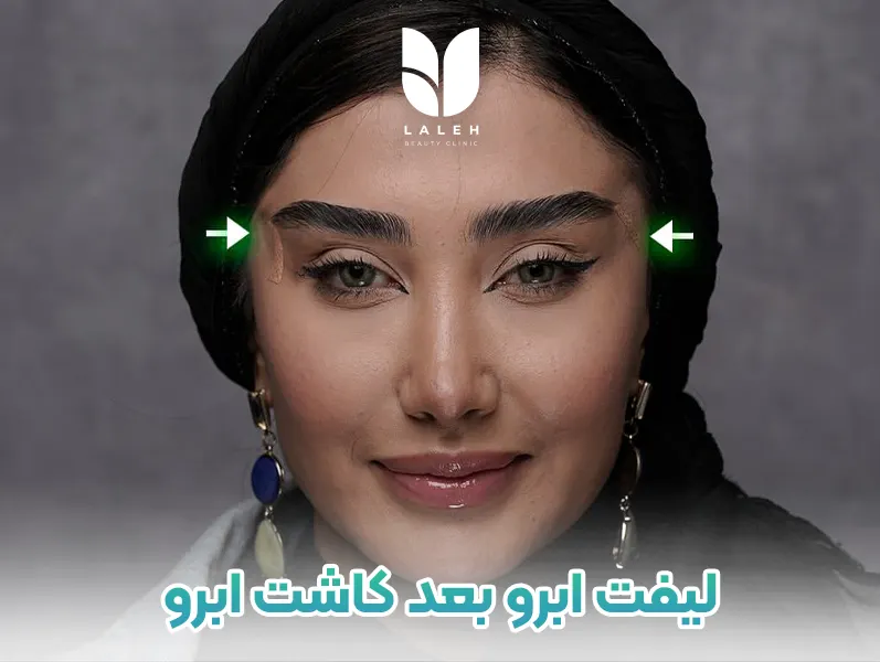 لیفت ابرو بعد کاشت ابرو