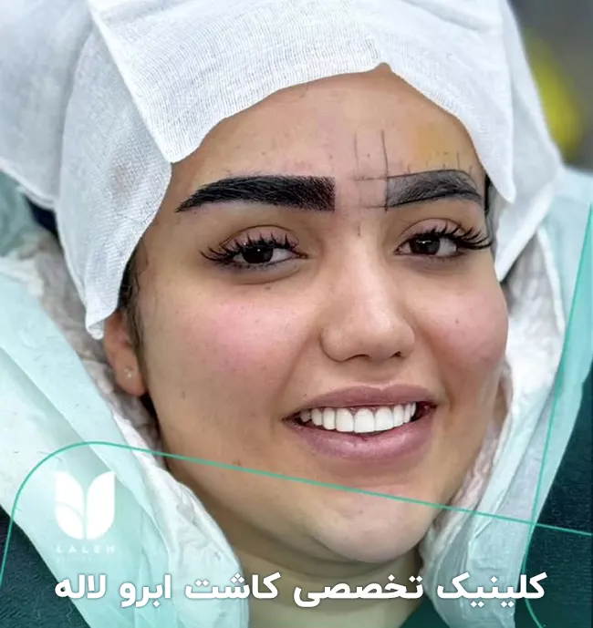 کاشت ابرو