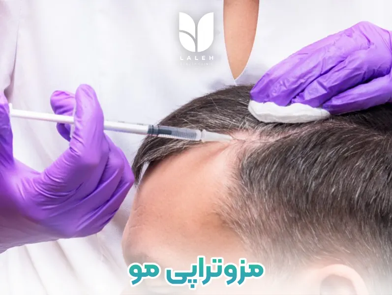 مزوتراپی مو
