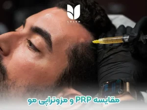 مقایسه prp و مزوتراپی مو بعد از کاشت مو