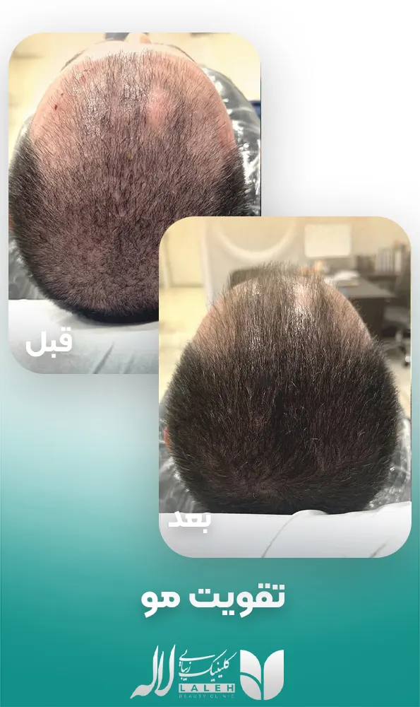 تقویت مو
