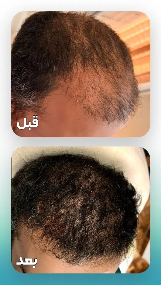 prp و مزوتراپی مو بعد کاشت مو