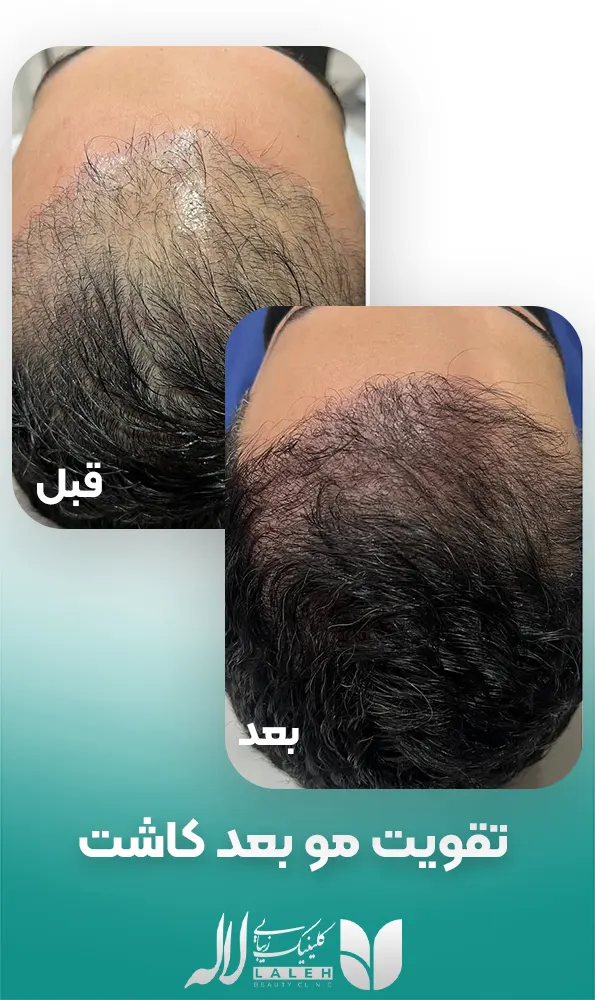 تقویت مو بعد کاشت مو