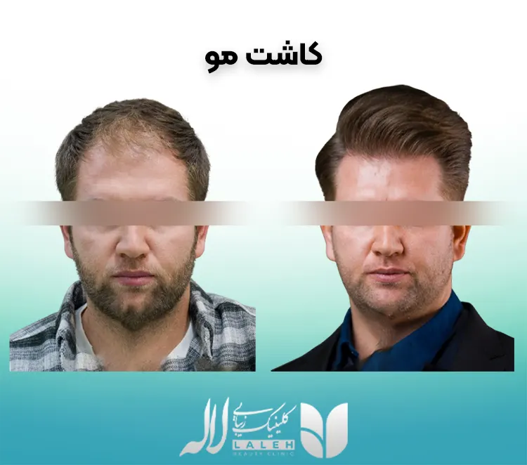 کاشت مو
