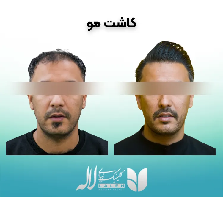 کاشت مو