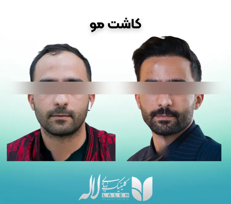 کاشت مو