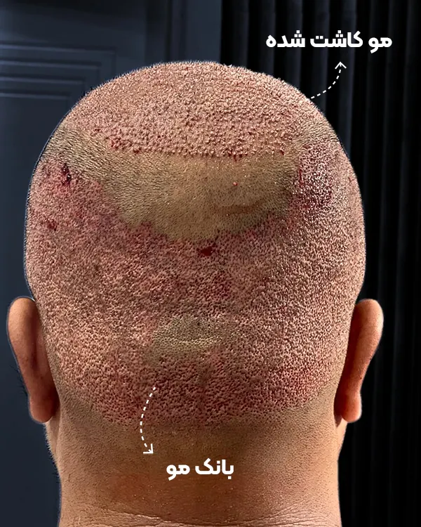 کاشت مو