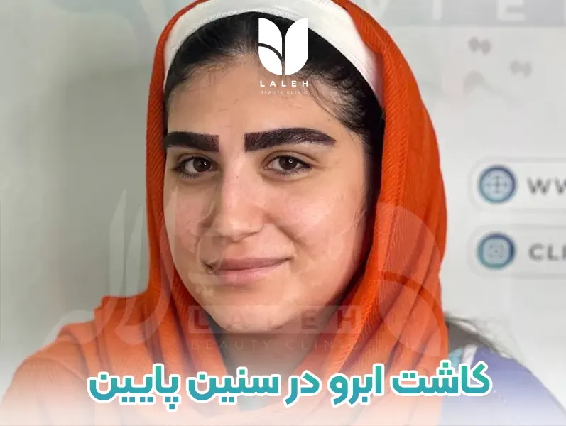 کاشت ابرو در سنین پایین