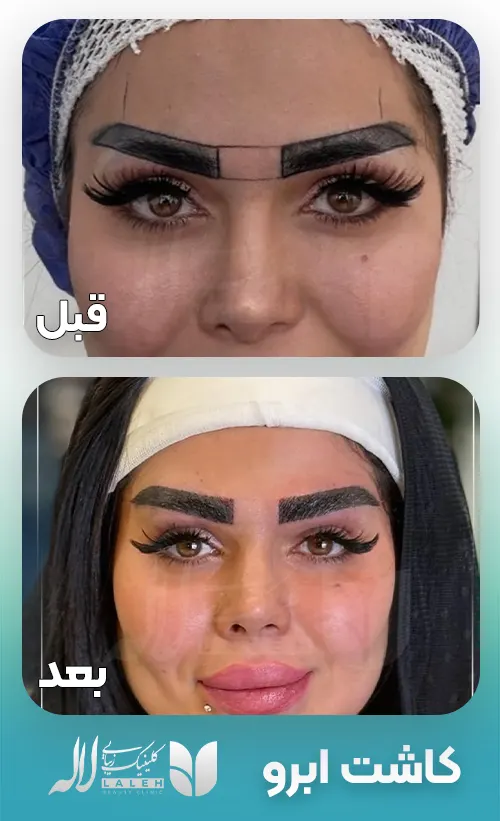 کاشت ابرو