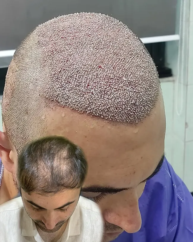 کاشت مو با بانک مو ضعیف