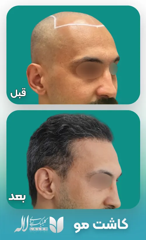 کاشت مو با بانک مو ضعیف