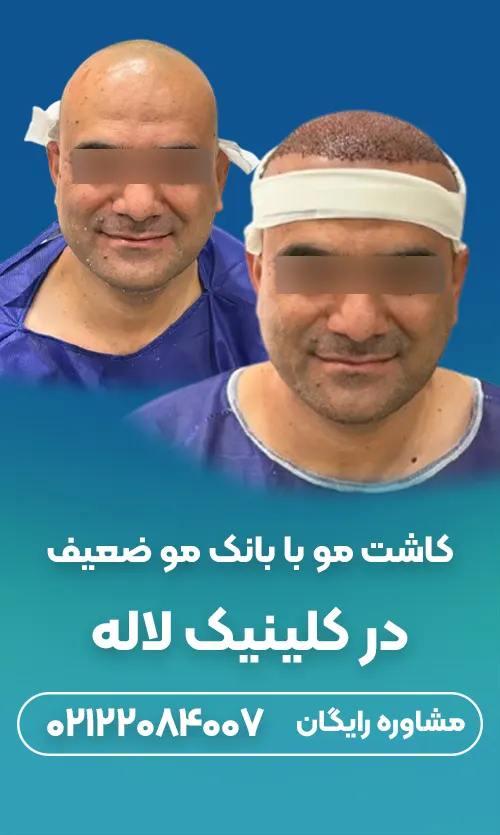 کاشت مو با بانک مو ضعیف