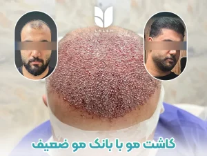 کاشت مو برای افراد با بانک مو ضعیف