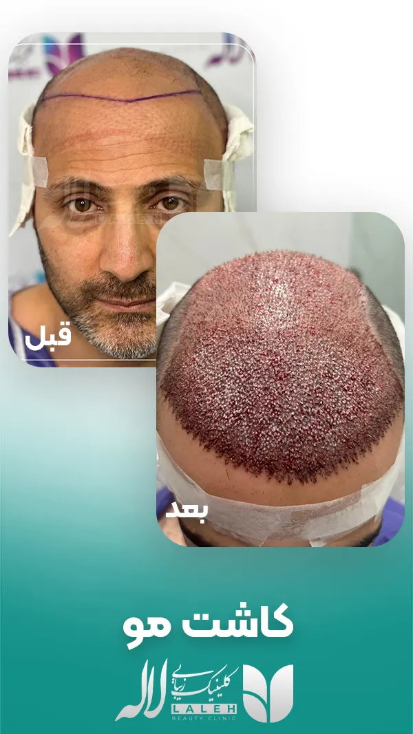 کاشت مو