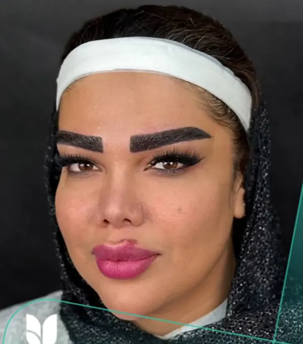 بعد کاشت ابرو