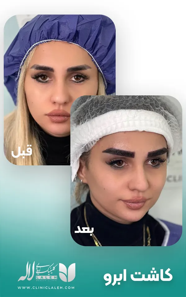 کاشت ابرو